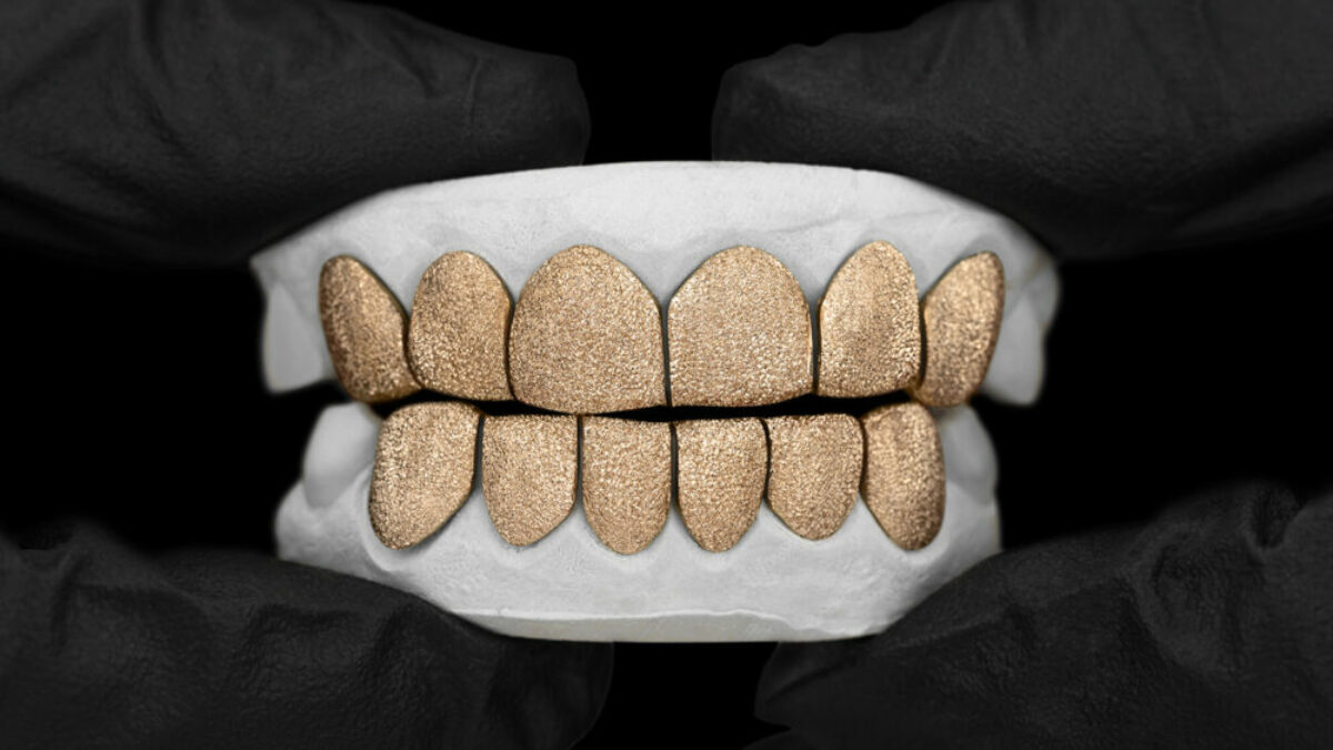 DIAMOND DUST EFFECT ON GOLD GRILLZ (#GoldGrillz) 